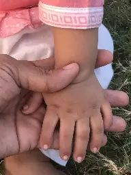 My niece has 6 fingers on both hands [OC]