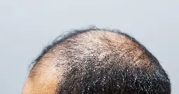 Drug that treats hair loss and thinning hair may be in short supply