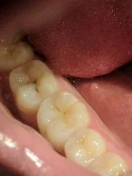 Are the black bits on these two teeth cavities?