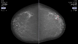 Can AI detect breast cancer?