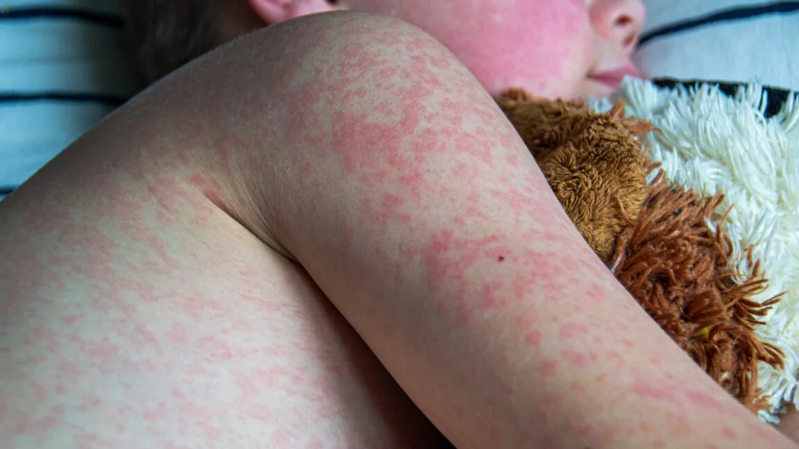 Measles outbreak erupts in one of Texas’ least vaccinated counties