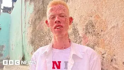 Somalis with albinism: Pelted with stones and raw eggs