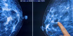 FDA’s new regulations underscore the complexity around screening for women with dense breasts